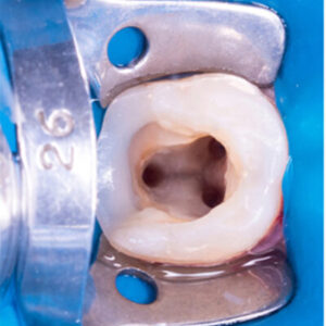 1-root-canal