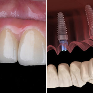 baja-oral-center-full-arch-all-on-4-service-tijuana