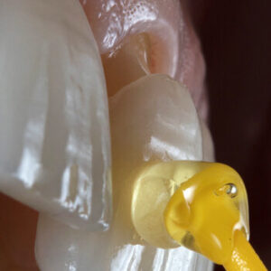 baja-oral-center-veneers-service-tijuana