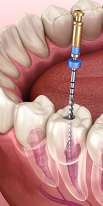 Alt Text for RootCanal