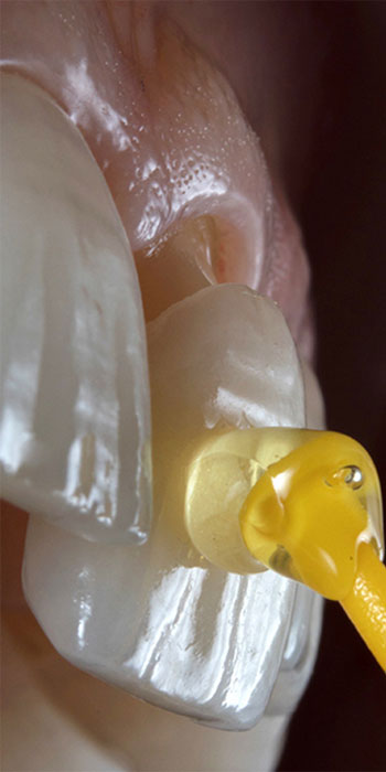 Alt Text for Veneers