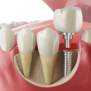dental-implants_872
